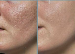 Microneedling